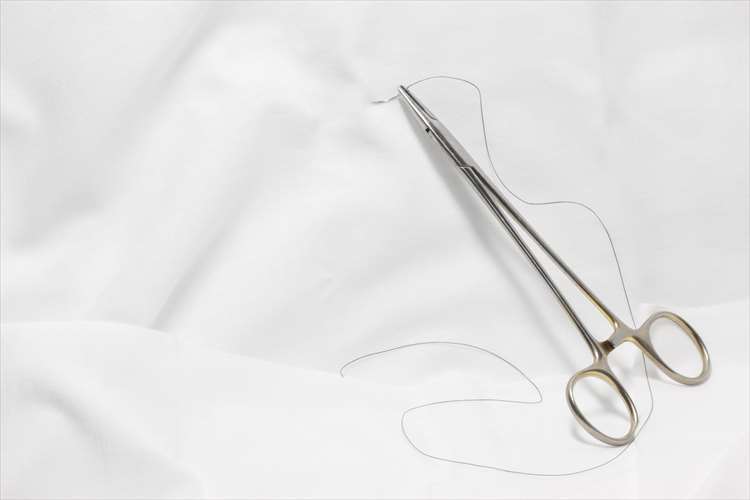 目尻切開の主な2種類の術式とそれぞれの特徴