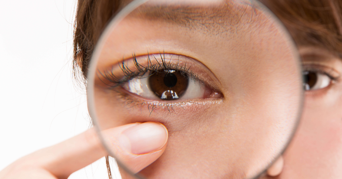 de ce ridurile de sub ochi după blefaroplastie