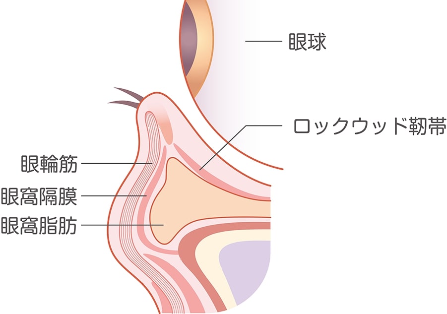眼窩脂肪の突出による目袋や影クマ