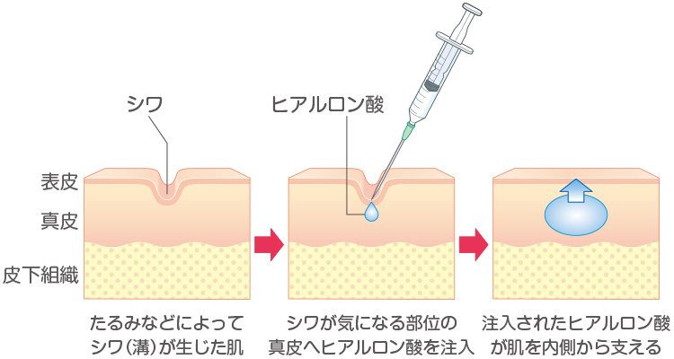 ヒアルロン酸注入